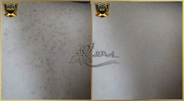Hình ảnh trước và sau khi điều trị viêm nang lông tại H&T Spa ở TPHCM.