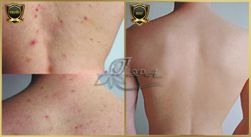 Hình ảnh trước và sau khi đến spa điều trị mụn lưng hiệu quả ở TPHCM