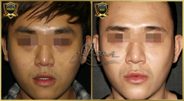 Trước và sau khi làm trắng da mặt cho nam giới hiệu quả tại H&T Spa.