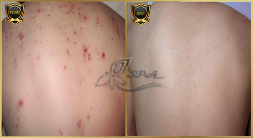 Hình ảnh trước và sau khi đến spa trị mụn lưng ở TPHCM